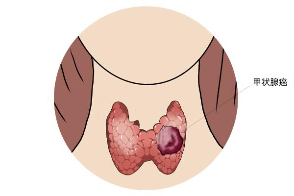 甲狀腺癌癥的主要癥狀表現(xiàn)有什么？為什么會得甲狀腺癌癥呢？